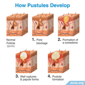 PUSTULE ACNE  SKINCARE SET
